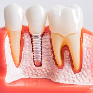 6 Myths About Dental Implants Near Me in Cranford