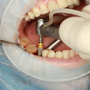 Emergency Dental Implants | Dental Surgeon Near You | Linden