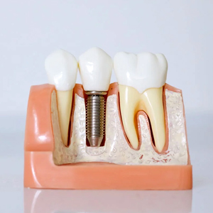 Why Hand-Pick Dental Surgeon for Dental Implants? | Cranford